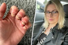 Woman issues warning after years of gel nails: ‘I thought I would lose a finger’