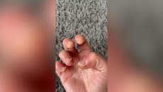 Watch: Mother ‘can barely move her hands’ after years of gel nails