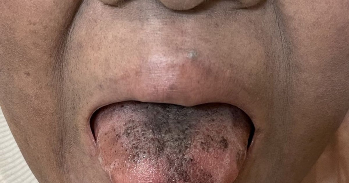 Cancer patient's tongue turned black and hairy 'after rare antibiotics reaction' | The Independent Cancer patient's tongue turned black and hairy 'after rare antibiotics reaction' | The Independent