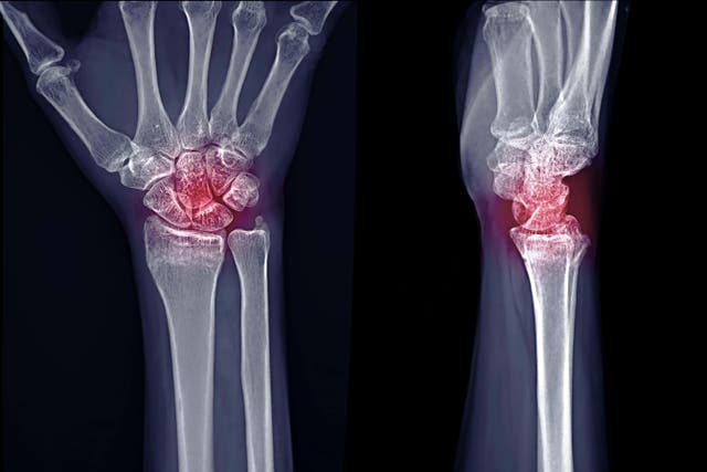 Opioids are sometimes prescribed for pain relief from rheumatoid arthritis in the short-term (Samunella/Alamy/PA)