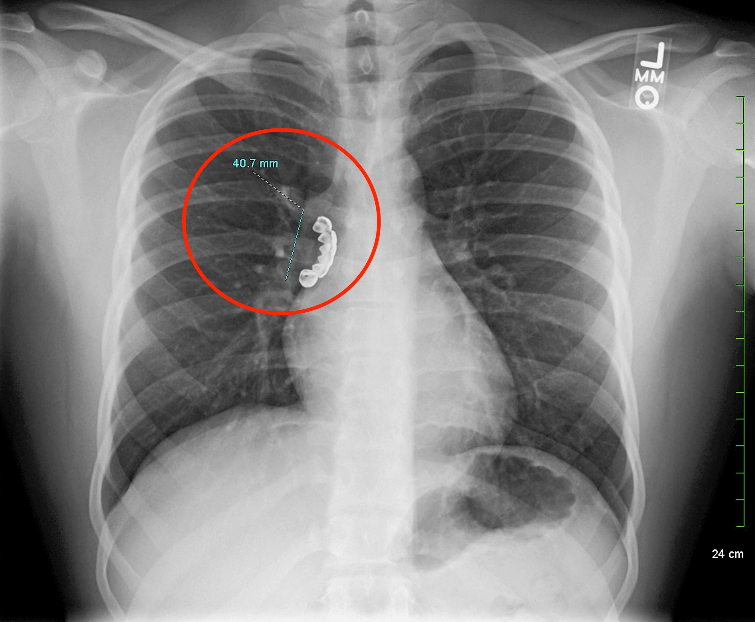 An X-ray image shows a man’s dentures lodged in his airway