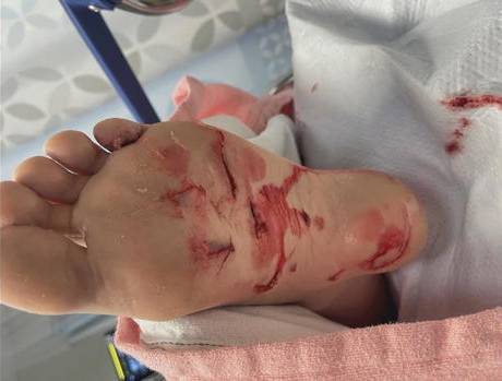 The 15-year-old suffered cuts to her foot and calf and needed six stitches