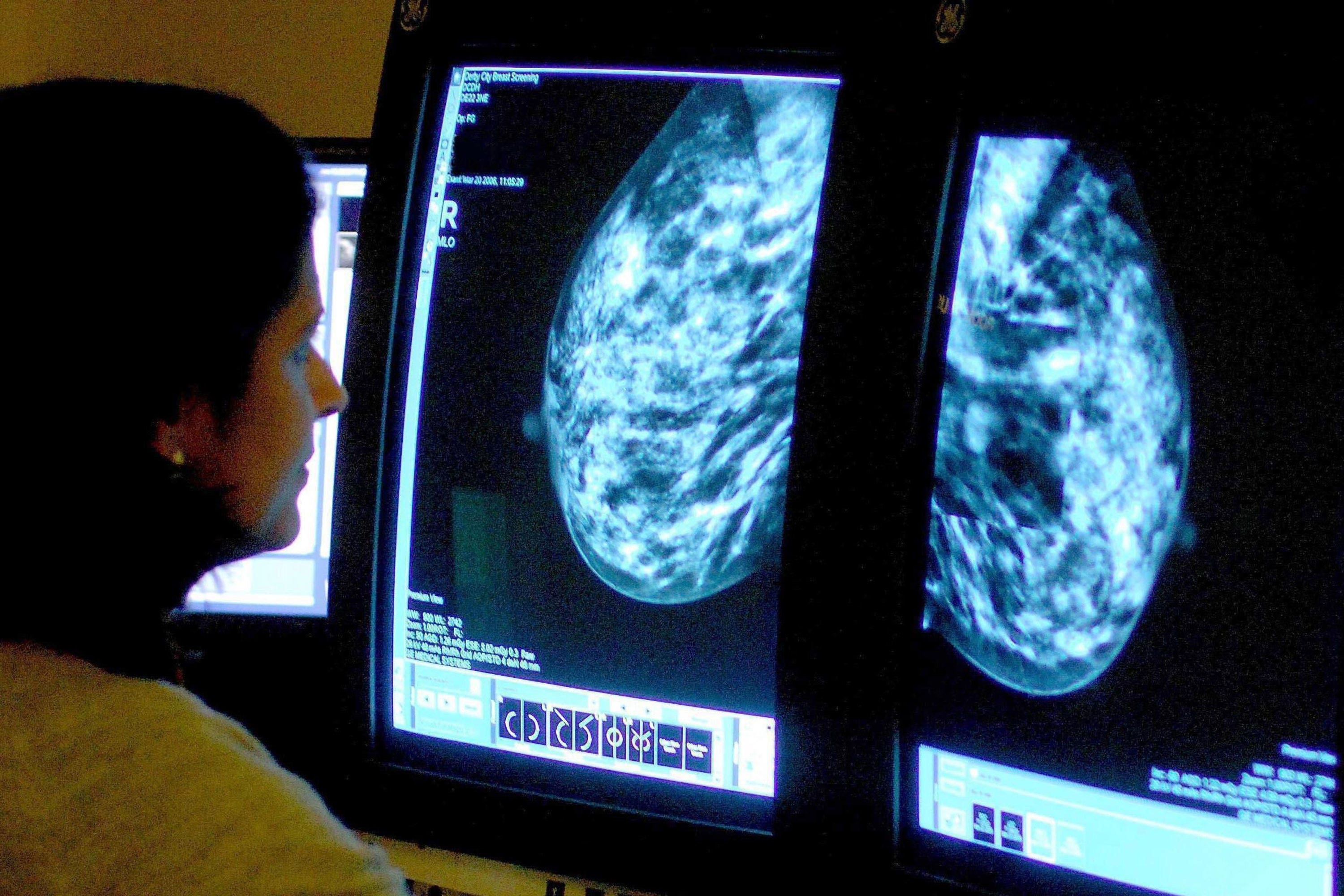 pa ready, scientists, breast cancer, breast cancer now, europe, ai model may predict if aggressive breast cancer will spread, research suggests