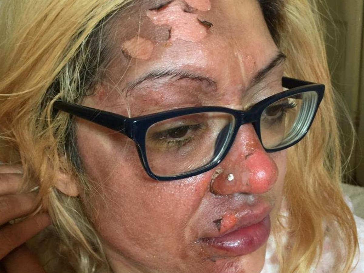 Mother issues warning after viral TikTok microwave egg recipe left skin peeling from her face