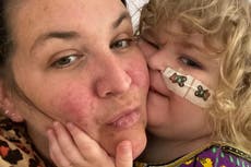 Parents call for herpes testing after son, 3, dies from virus