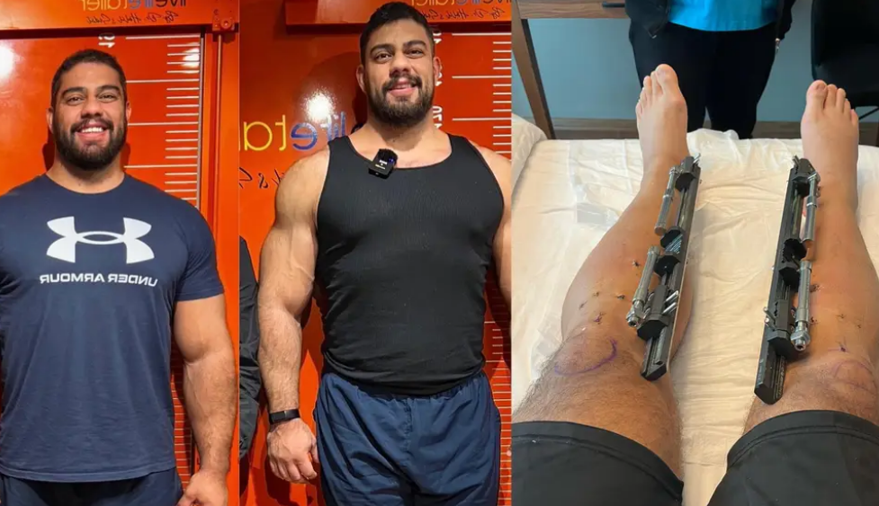 Turkey Leg Lengthening Surgery Georgia Man Has 86 000 Surgery To Make