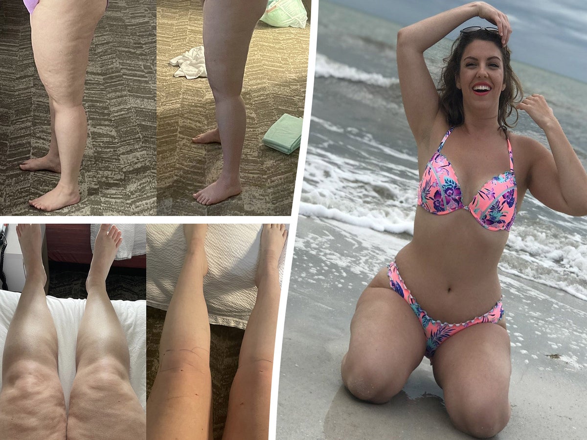 Ozempic for legs? 'Calf tox' is newest slimming fad on TikTok