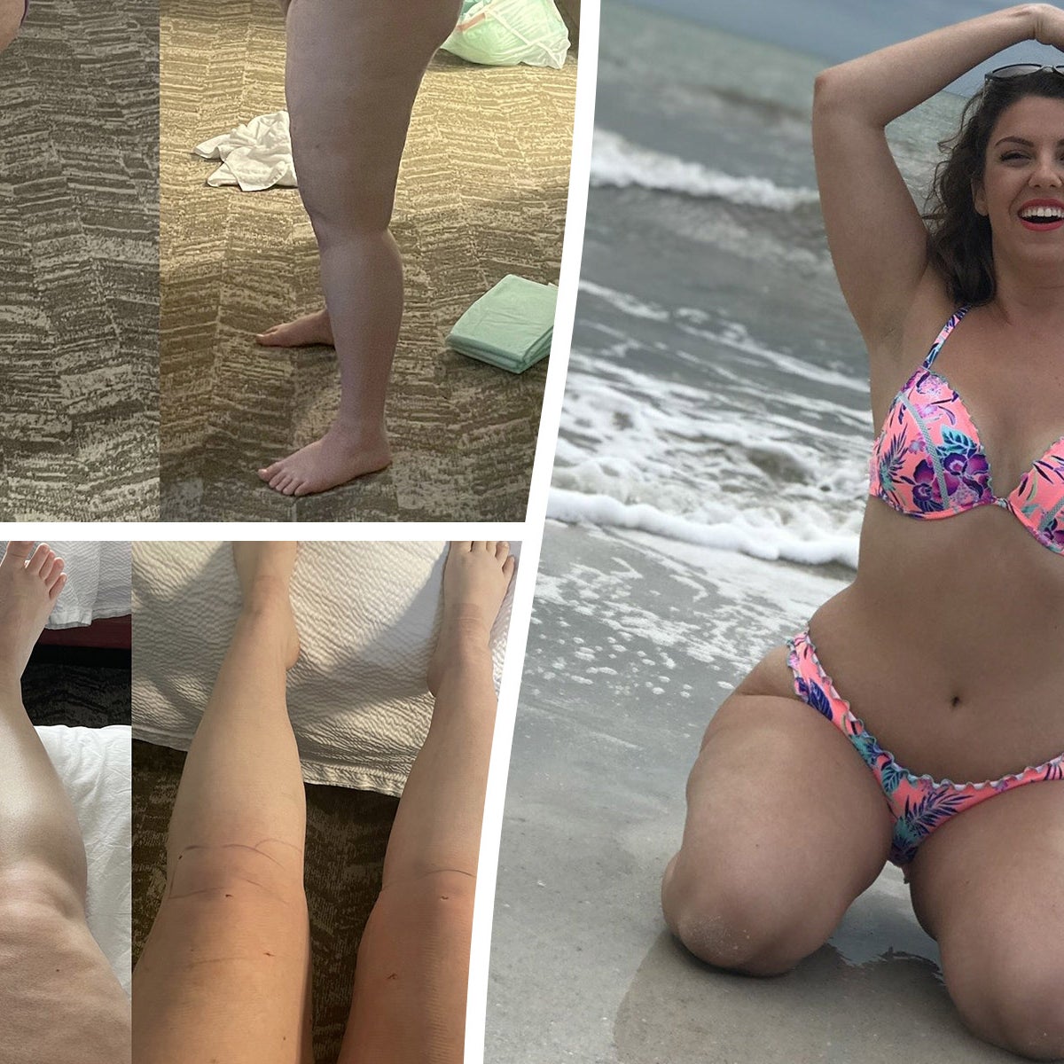 semaglutide for lipedema BREAKTHROUGH?, Weve been waiting on a GLP-1 study! , A brand new study out of Italy just gave us *real hope*., Five women with lipedema and insulin resistance were treated with a once-weekly Woman took higest dose of