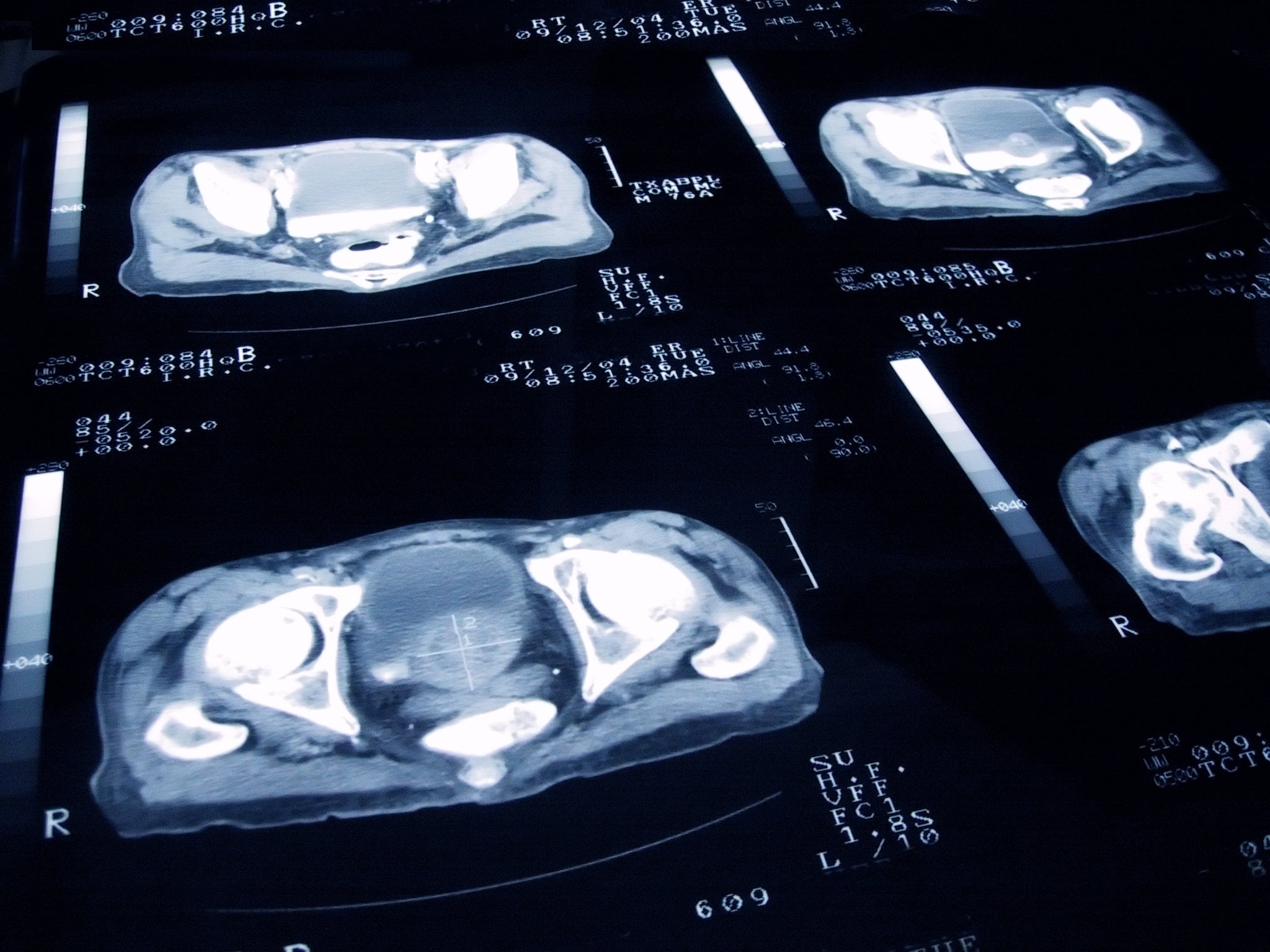 Prostate cancer scans as AI discovers there are two subtypes