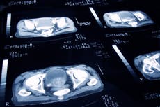 ‘Game changing’ prostate cancer trial could save thousands of lives