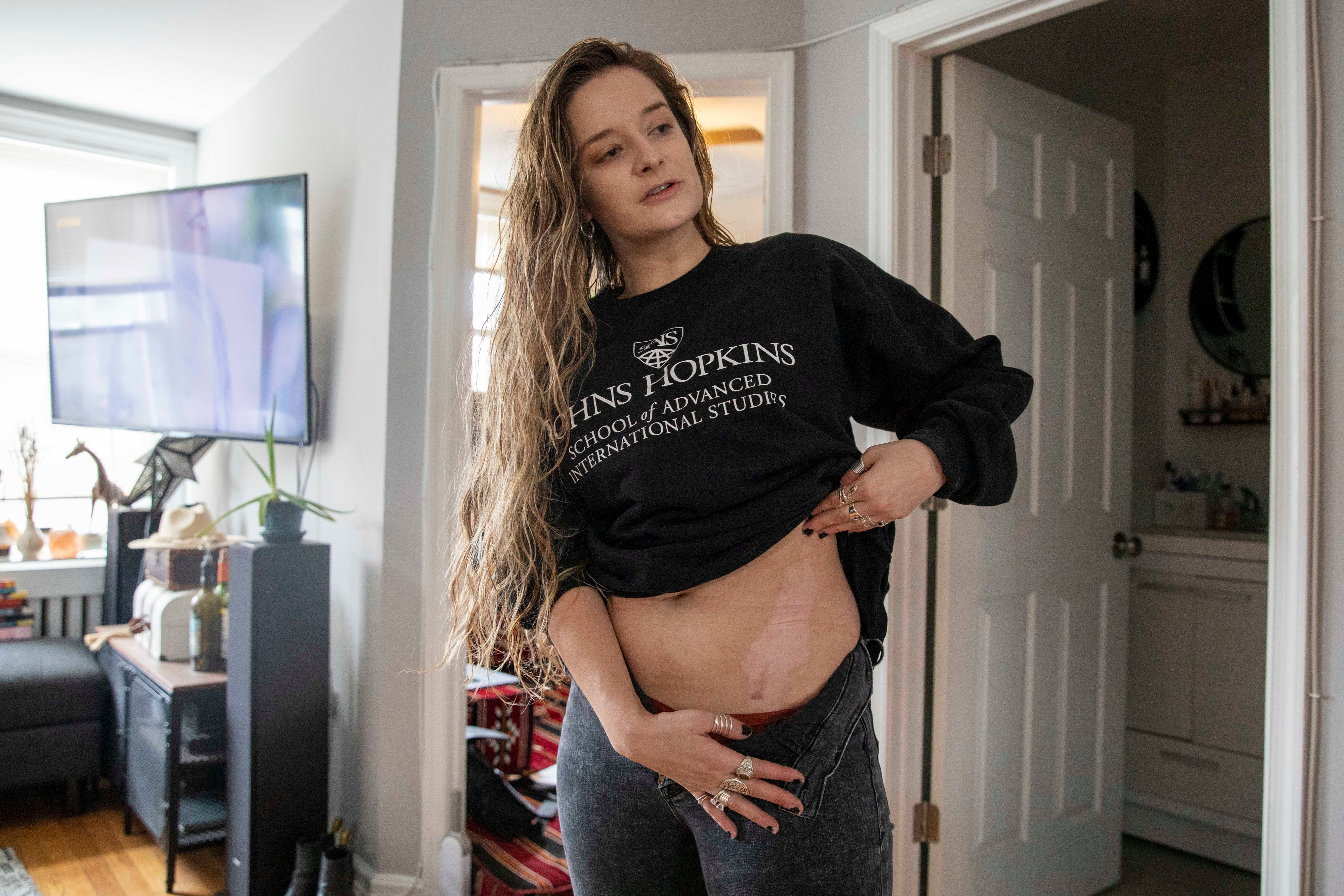 Amber Escudero-Kontostathis shows a scar from being struck by lightning last August, at her home in Washington on 10 March