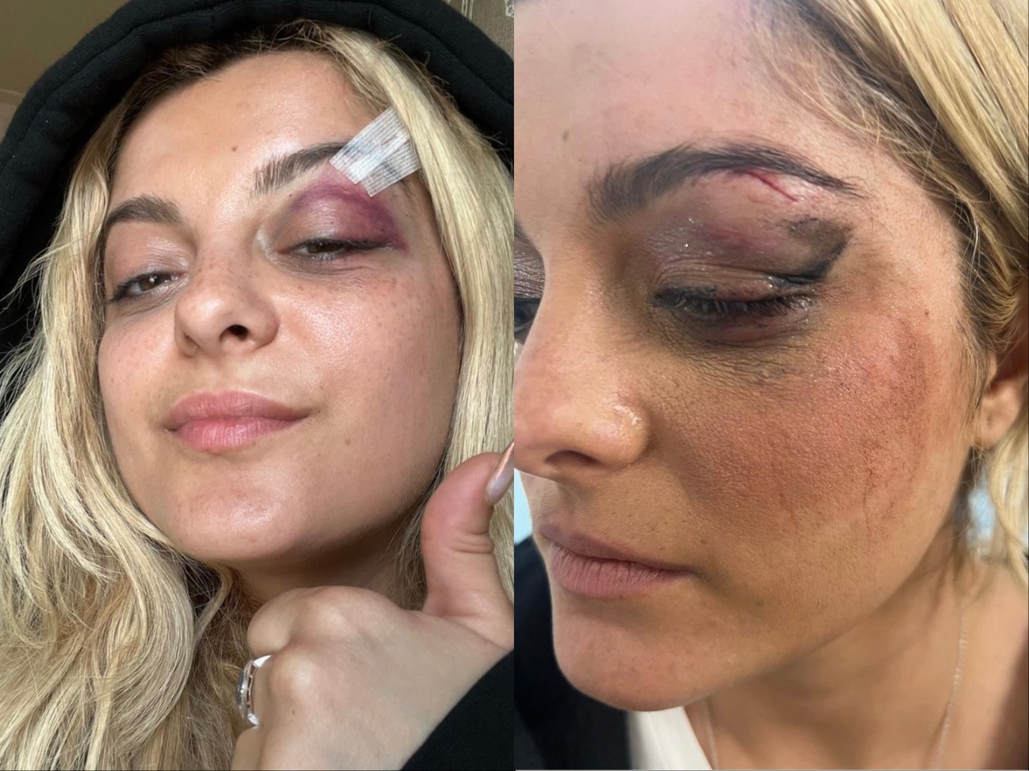 Bebe Rexha shows her injuries on Instagram
