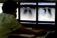 New dual-action drug a ‘promising step forward’ for patients with hard-to-treat lung cancer