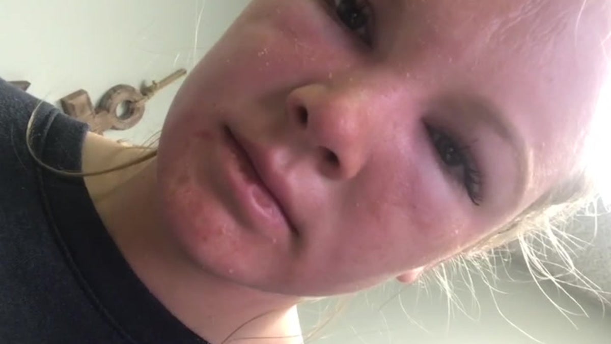 Watch: What the dangerous effects of sun poisoning look like