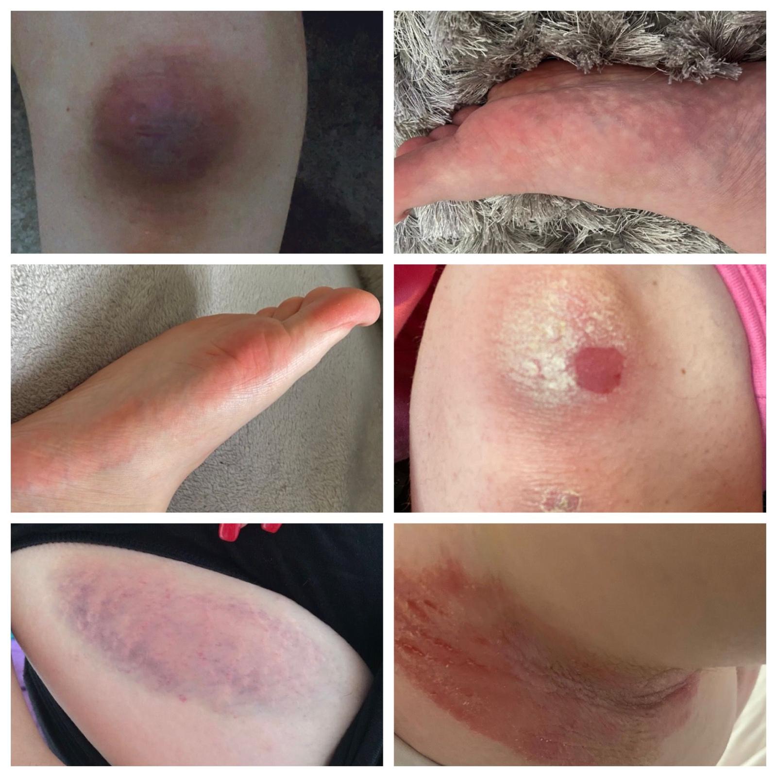 Photos show the impact of the disease on Amelia’s body as her skin peels and bruises
