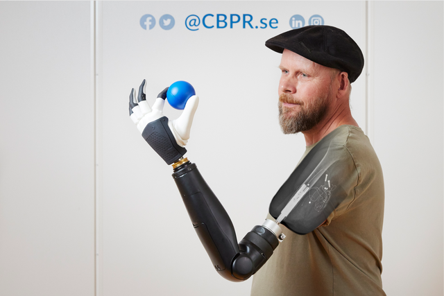 Tonney wearing a prosthetic arm directly attached to the skeleton and neuromuscular system, which after surgical reconstruction of his residual limb, allows him to control individual fingers of a bionic hand (Anna-Lena Lundqvist/Chalmers University of Technology)