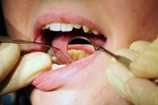 People forced to pull out their own teeth amid NHS dental crisis, report finds