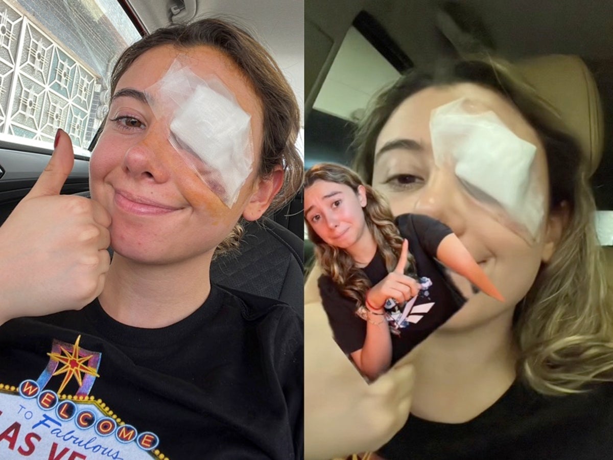 Woman requires eye surgery after using social media hack to remove makeup