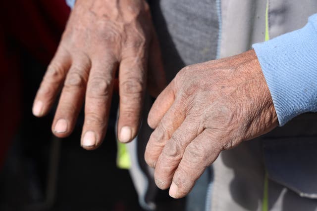 <p>An elderly man shows his hands </p>