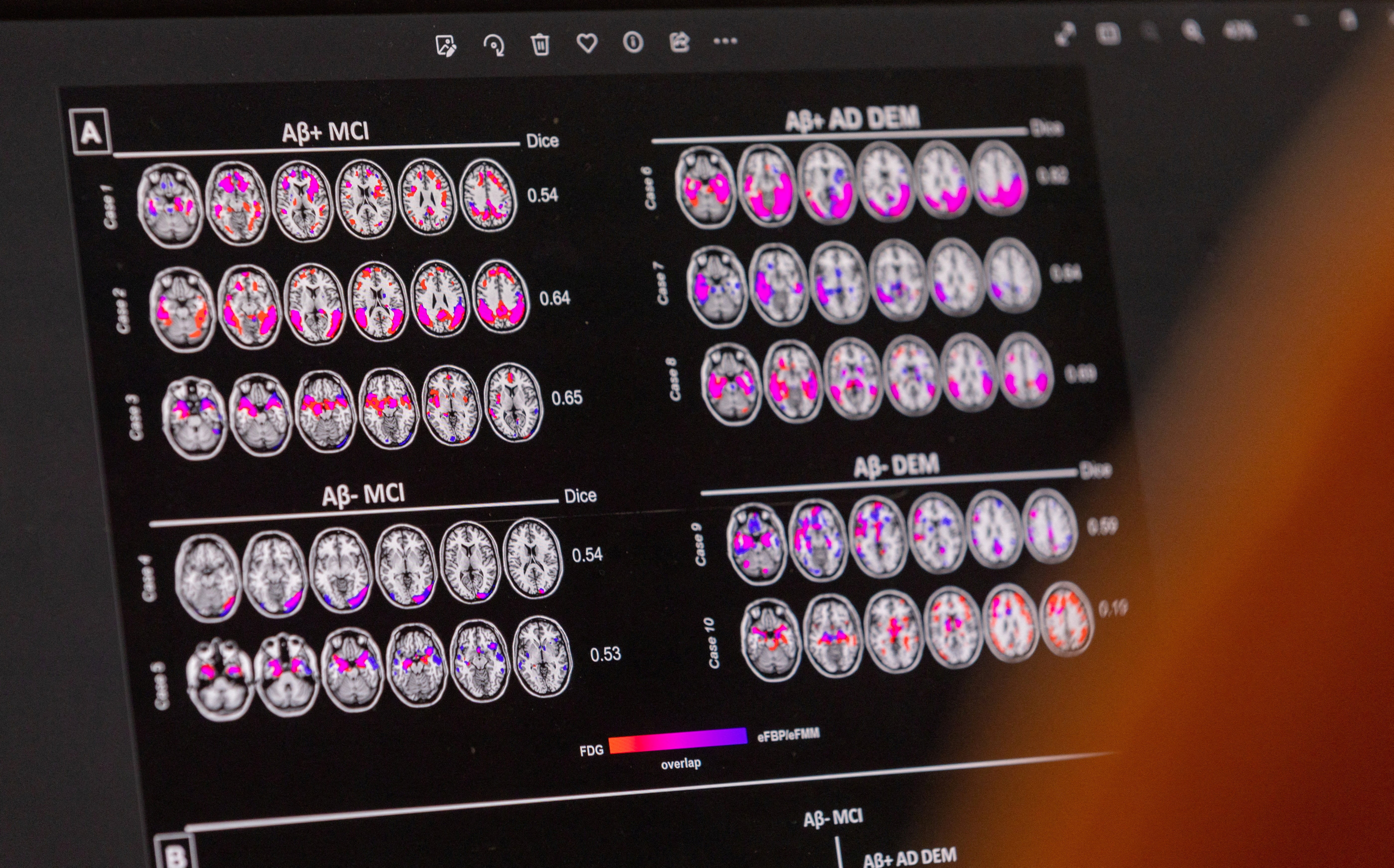 A scientist looks at brain patterns of a patient suffering from Alzheimer's disease