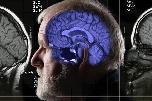 The development of the new drug could have significant implications for the treatment of Alzheimer’s (Alamy/PA)