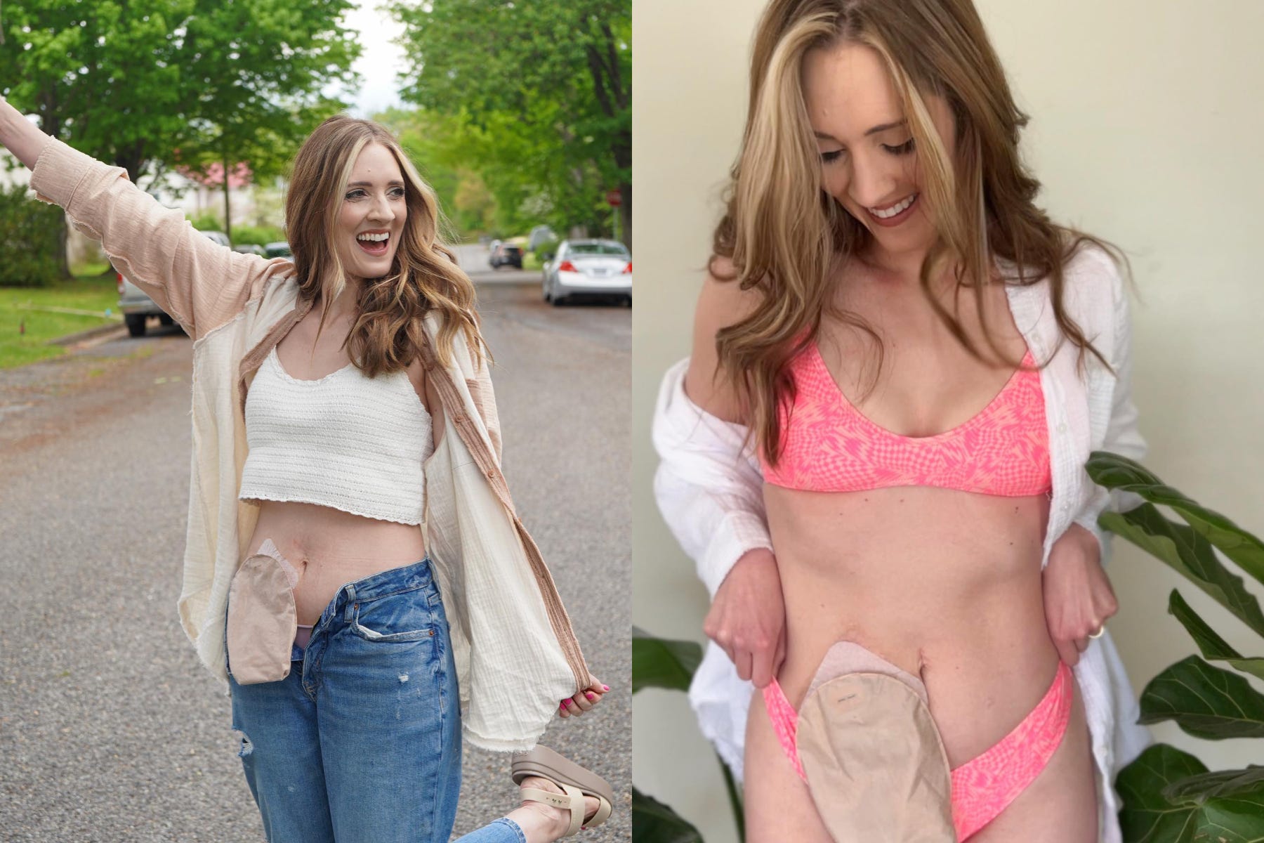 Mum with stoma bag shares bikini pictures to celebrate 'second chance at  life