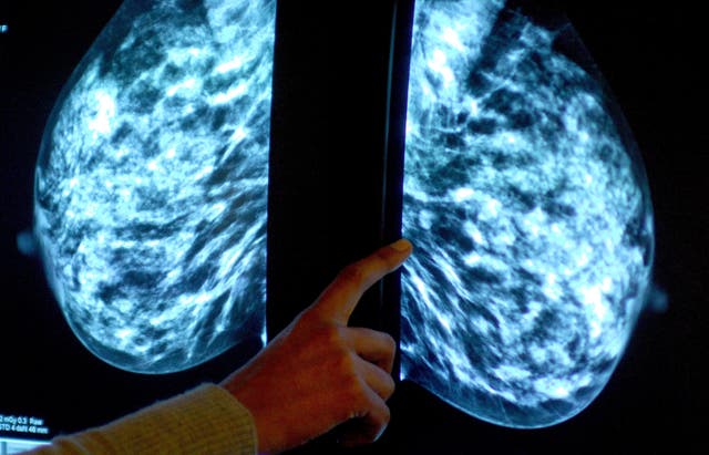 <p>A mammogram shows a woman's breast being checked for breast cancer at Derby City Hospital</p>