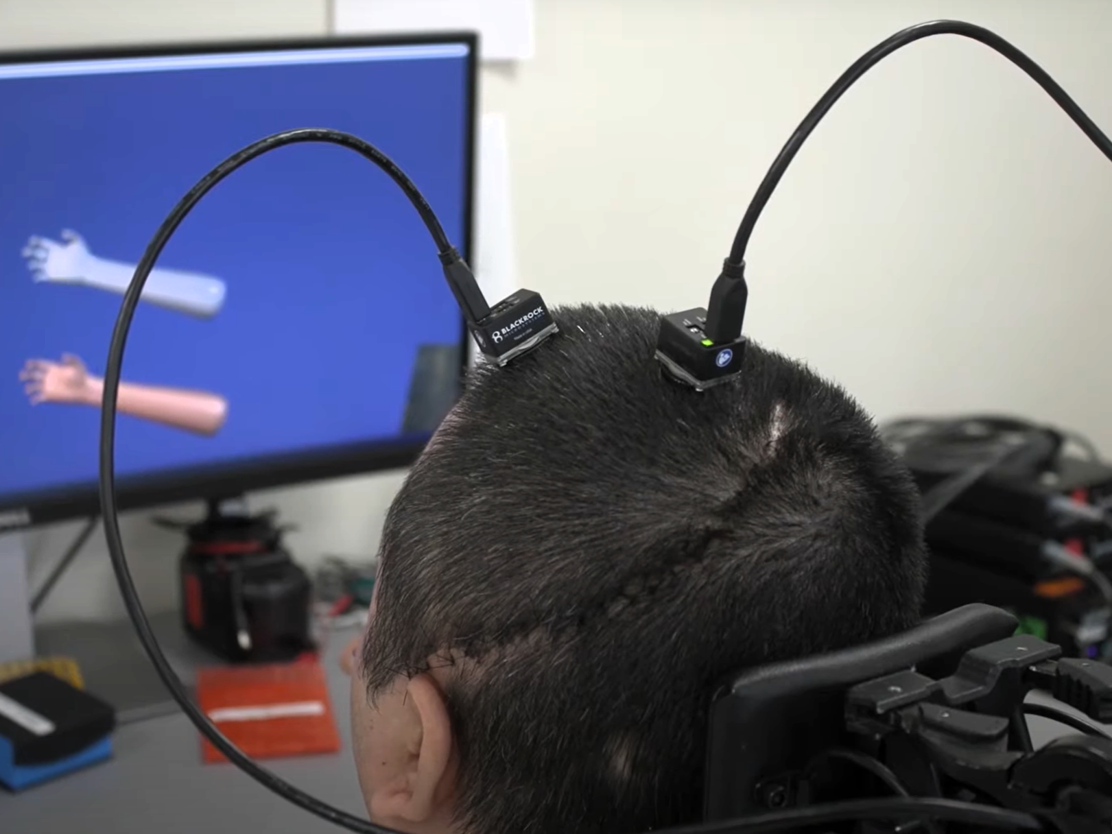 Researchers restored the sense of touch and movement for Keith Thomas using brain implants, artificial intelligence and novel stimulation technology