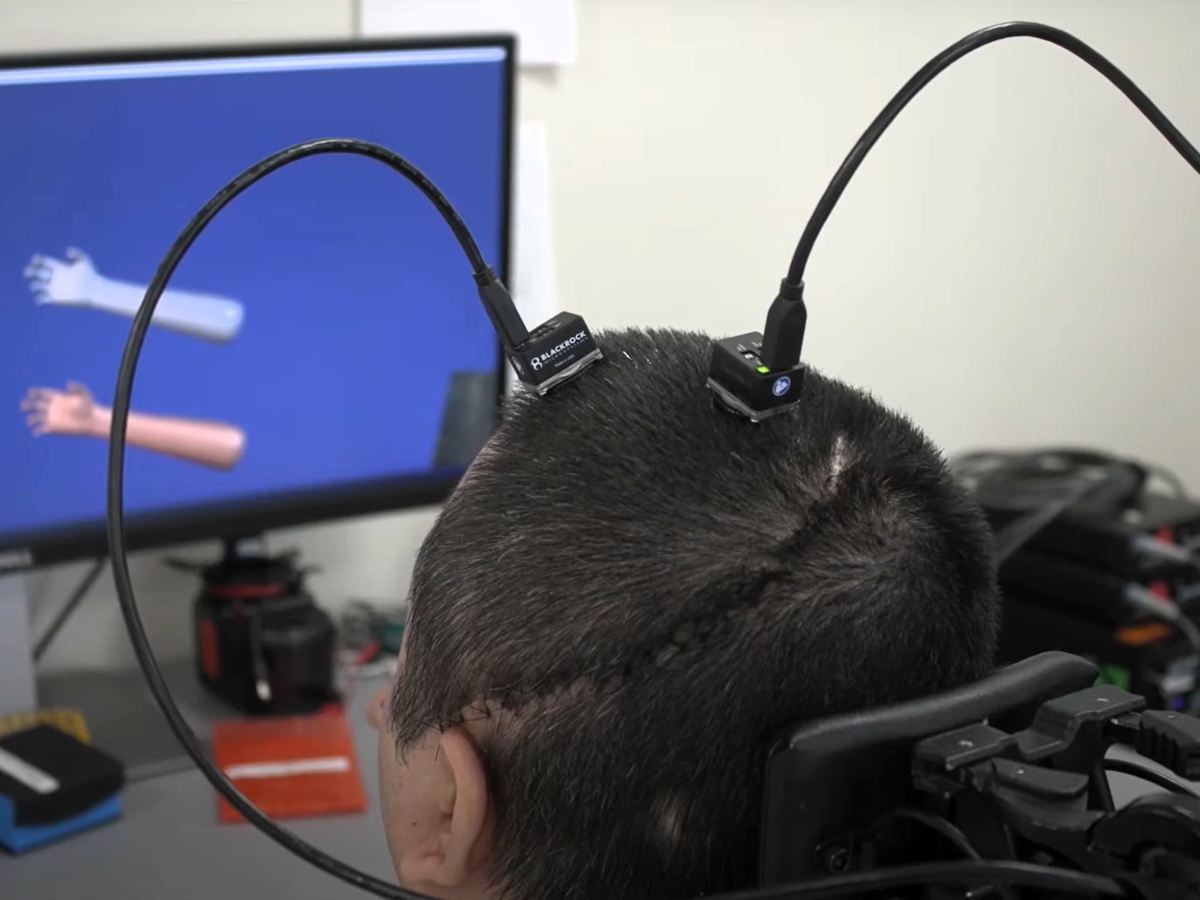 Paralysed man regains feeling and movement with AI brain implant