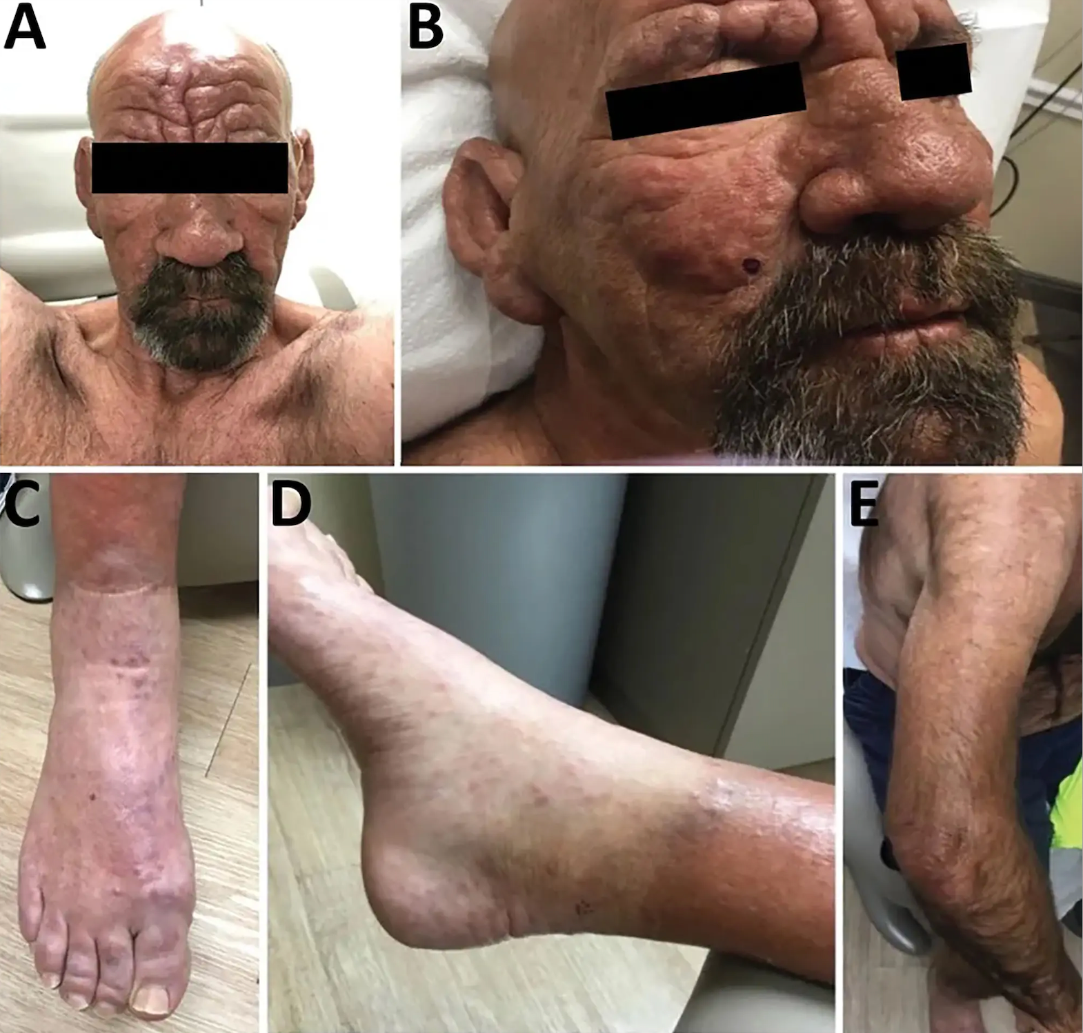 A 54-year-old Florida man reported to a dermatology clinic suffering from leprosy