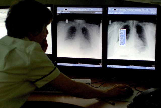 An NHS trust in Surrey found the Qure AI program identified normal chest X-rays with a 99.7% accuracy (PA)