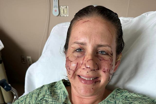 <p>Jen Royce in the hospital after the otter attack</p>