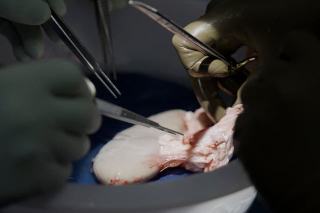 Pig Human Transplants