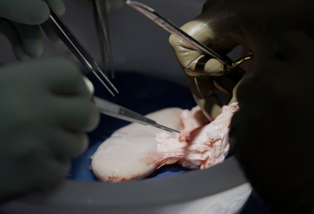 Pig kidney works in a donated body for over a month, a step toward animal-human transplants