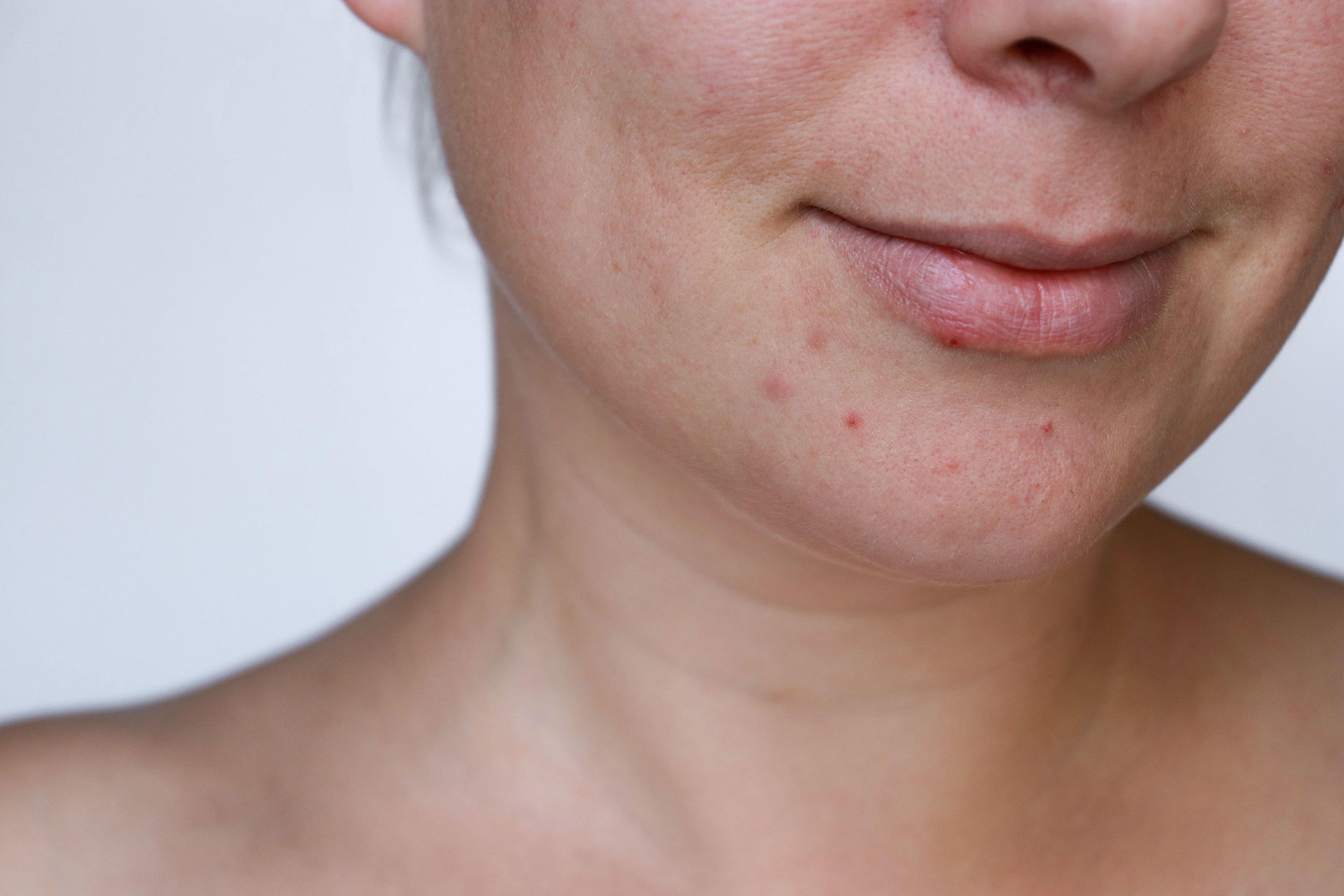 Different types of acne scarring require varying treatments (Alamy/PA)