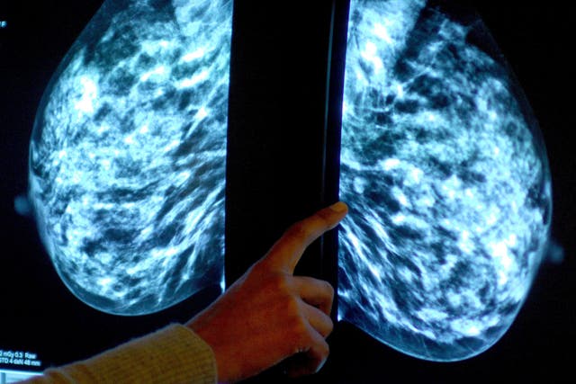 Current breast cancer screening can lead to overdiagnosis and unnecessary treatments, scientists say (Rui Vieira/PA)