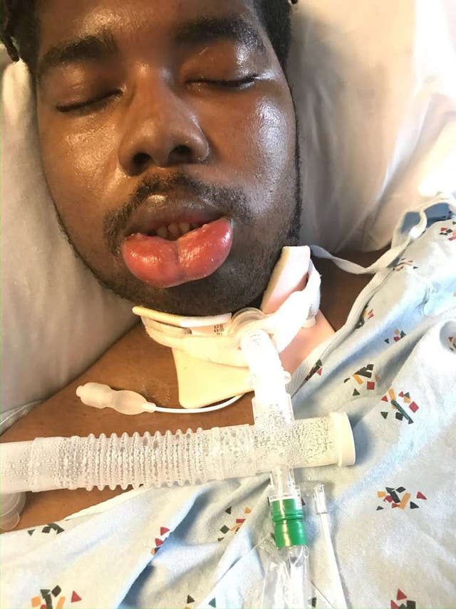 Nathaniel ‘Nueva Jersey’ Foster después de sufrir daño cerebral al desembarcar de un vuelo de United Airlines en 2019