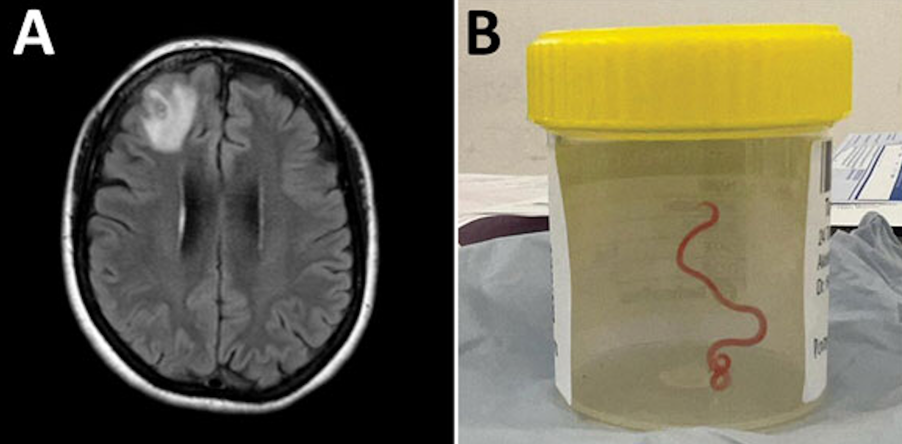 Detection of ‘Ophidascaris robertsi’ nematode infection in a 64-year-old woman from southeastern New South Wales, Australia