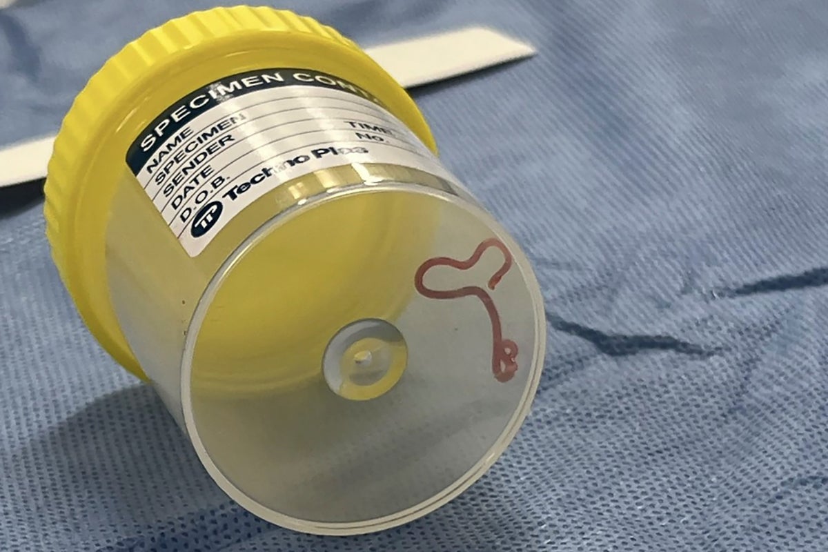 ‘Alive and wriggling’ parasitic worm removed from brain of Australian woman