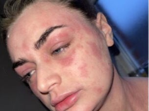 <p>Rhiannon Kennedy-Chapman was left in agony after red rashes broke out all over her body </p>