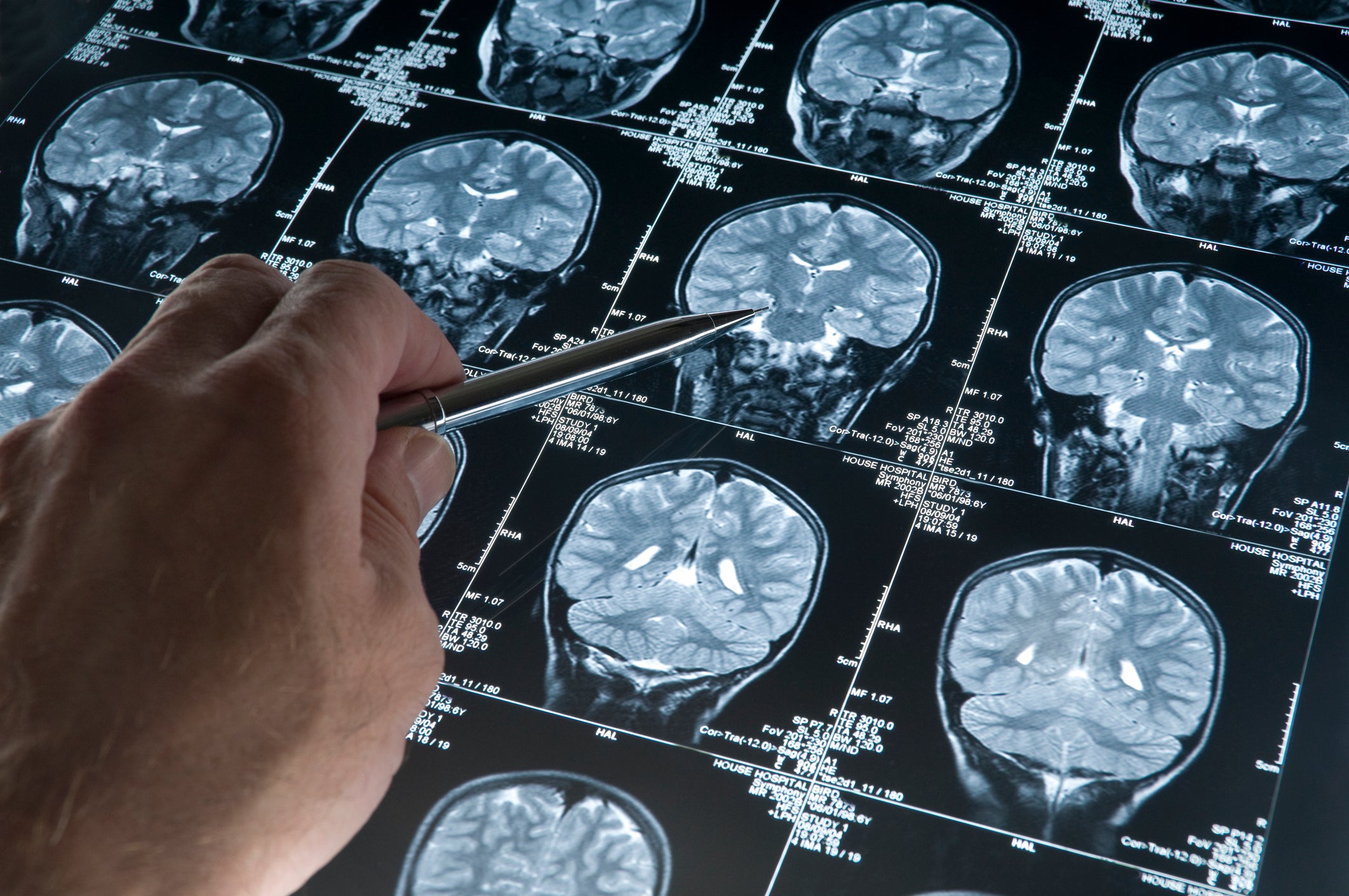Representational photo of an MRI brain scan of head and skull