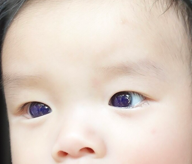 <p>A six month old’s eyes turned from brown to blue after taking a Covid drug that has not been authorized or approved in the US.</p>