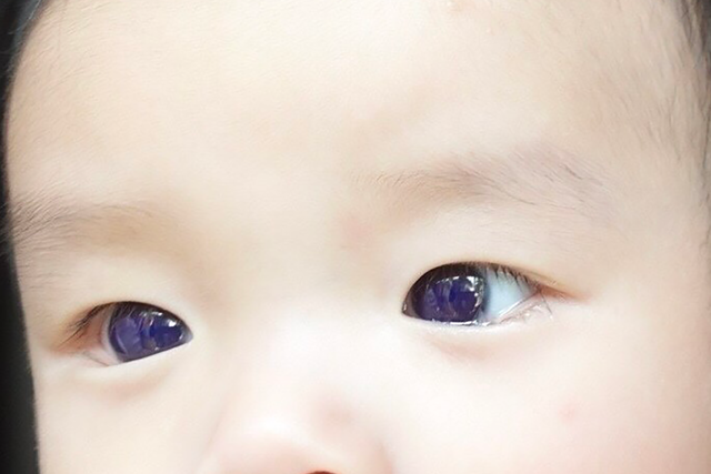 <p>A six month old’s eyes turned from brown to blue after taking a Covid drug that has not been authorized or approved in the US.</p>