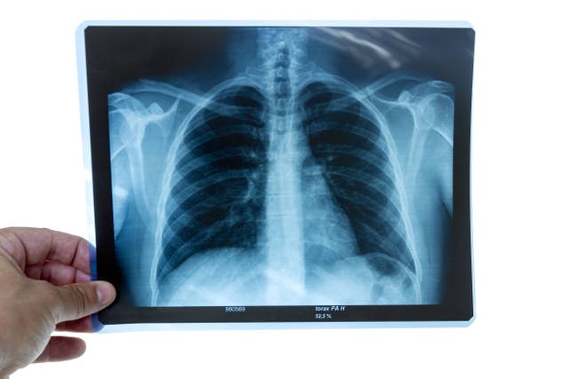 A doctor examining radiography of a ribcage (Alamy/PA)