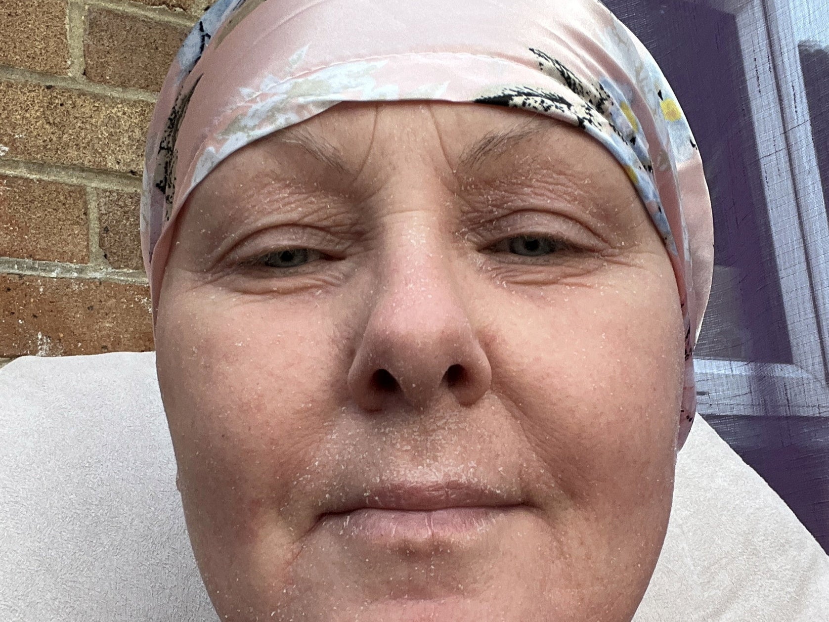 Sharon Shute said she lost nearly all her hair and had to give up work after going through severe topical steroid withdrawal