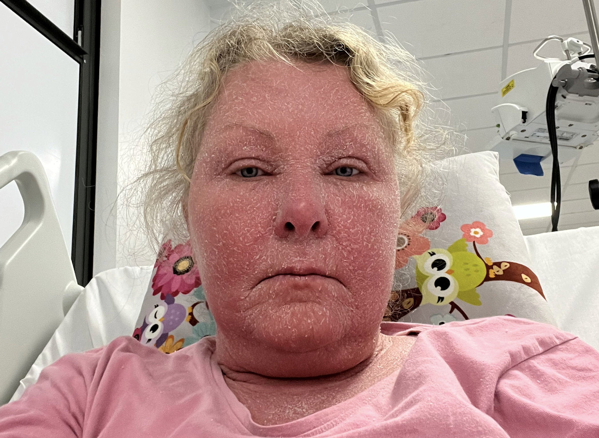 Sharon Shute said it felt like her face was on fire as she went through severe topical steroid withdrawal