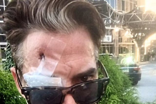 <p>Will Keenan reveals his bandaged left eye, which was blinded after someone attacked him for wearing a Covid-19 mask</p>