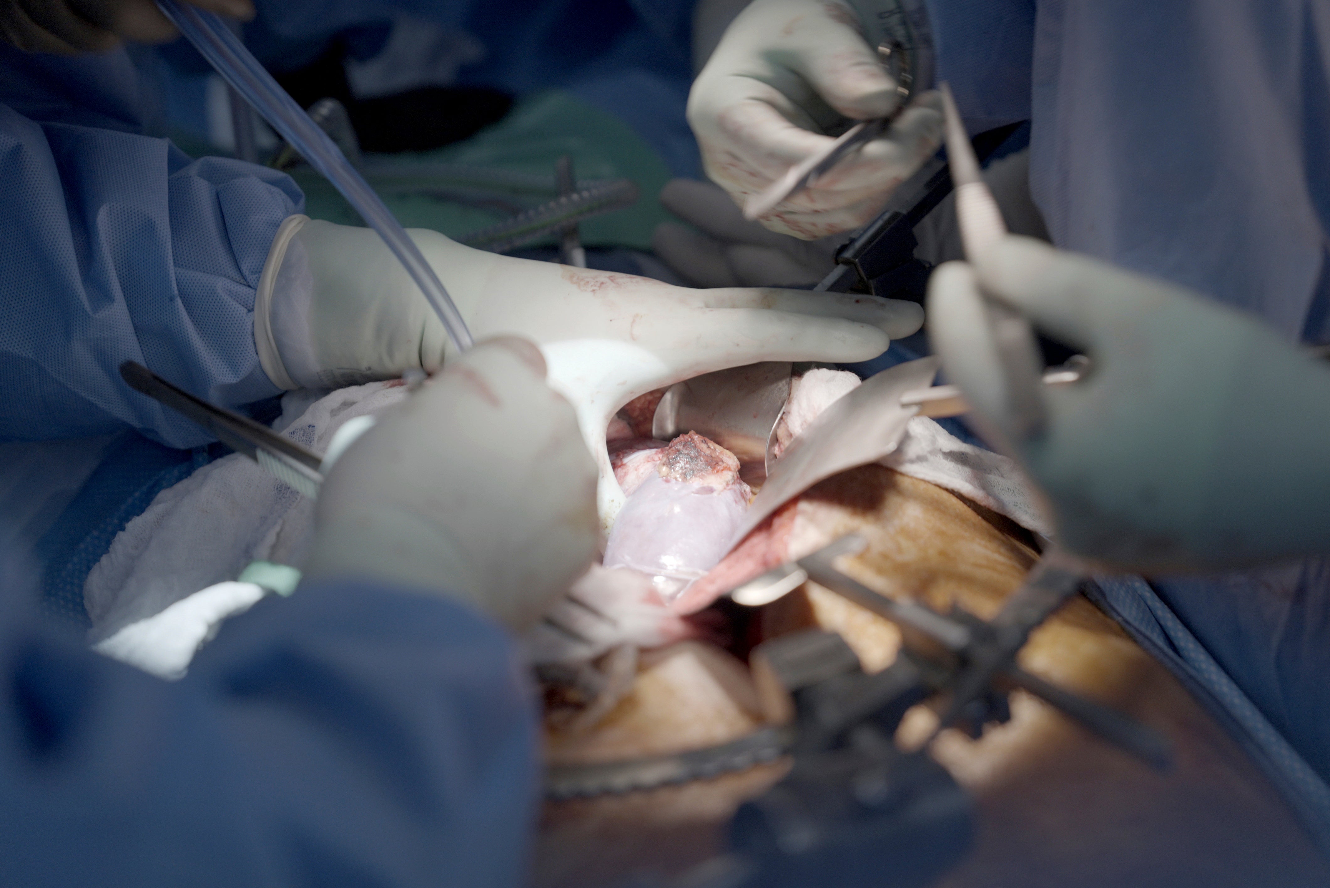 Pig Kidney Transplant Experiment