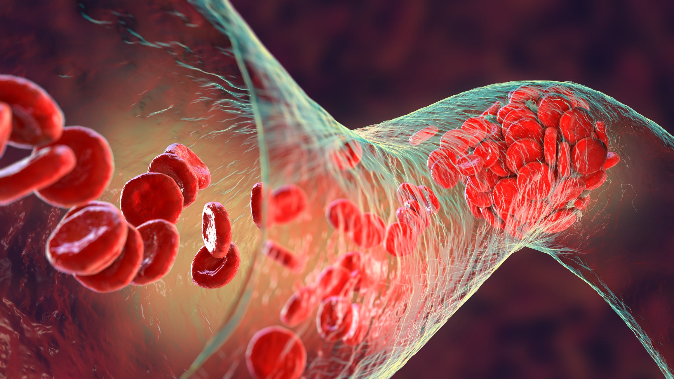 <p>Blood clot made of red blood cells, platelets and fibrin protein strands. Thrombus, 3D illustration</p>