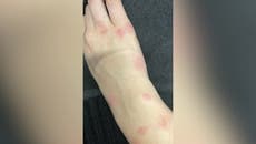 Paris tourist shows off arm covered in bedbug bites from staying in Airbnb